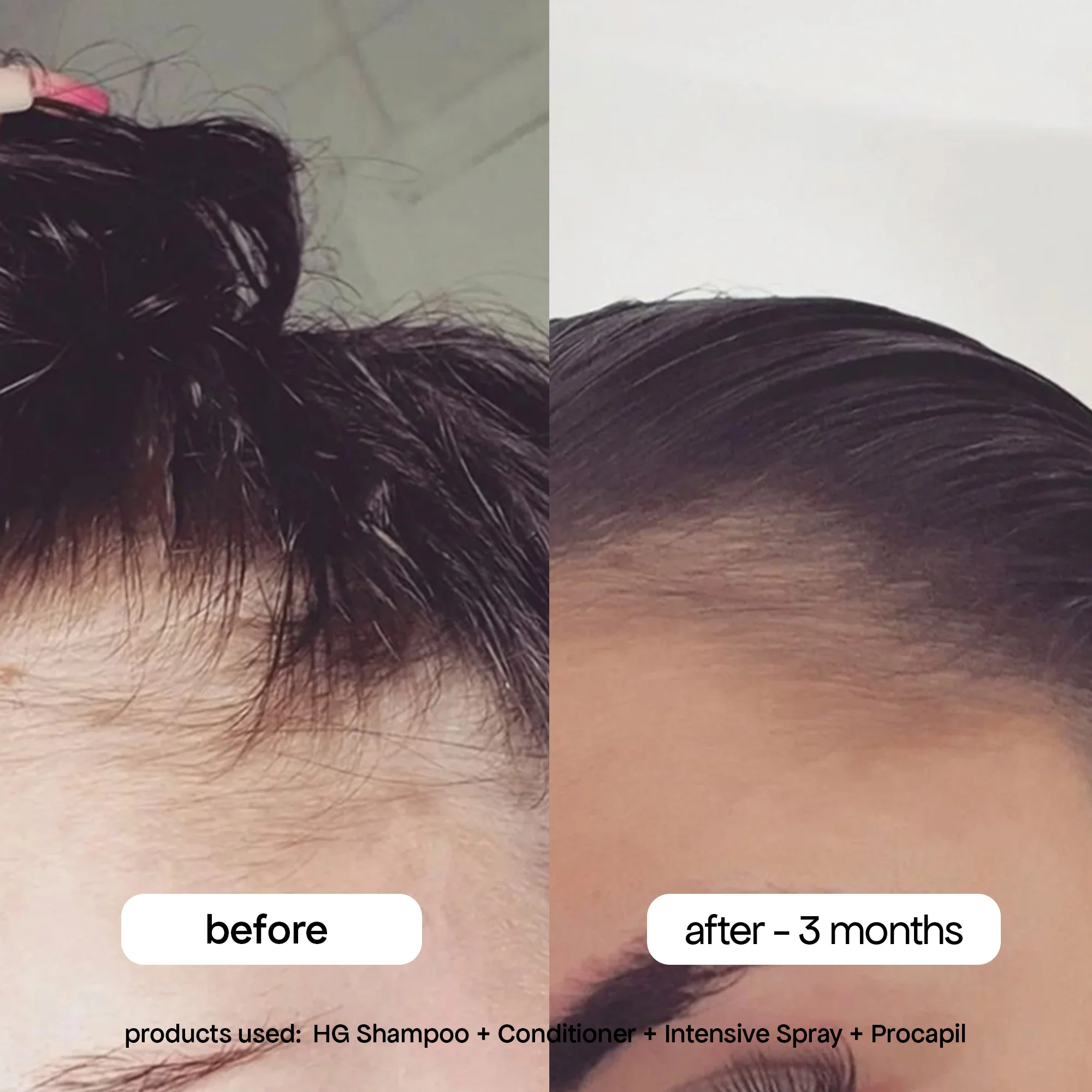 ANTI-THINNING PROCAPIL® SCALP TONIC - Image 11